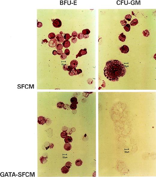 Fig. 5. Immunocytochemical staining for ▵LNGFR in pools of BFU-E (left) and CFU-GM (right) colonies from methylcellulose clonal cultures of CD34+ hematopoietic progenitors transduced with the SFCM (upper panels) and GATA-SFCM (lower panels) vectors. ▵LNGFR+ cells appear in red after APAAP staining. The bar is 10 μm.