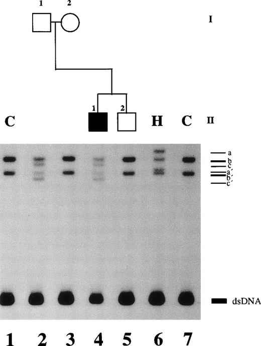 Fig. 2. SSCP analysis of plasminogen gene exon 2 in patient no. 1, his healthy parents, and his healthy brother and in healthy subject H. Radiolabeled single-stranded PCR products of plasminogen exon 2 were electrophoresed in a nondenaturing 5% polyacrylamide gel as described in Materials and Methods. Lane 1, healthy control (C); lane 2, father of patient no. 1; lane 3, mother of patient no. 1; lane 4, patient no. 1 with ligneous conjunctivitis; lane 5, brother of patient no. 2; lane 6, healthy subject H; lane 7, healthy control. dsDNA, double-stranded DNA.