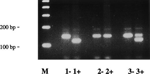 Fig. 4. Direct detection of plasminogen exon 7 mutation in patient no. 2 by amplification mutagenesis. A part of plasminogen exon 7 containing the mutation (G → A at position 780) was amplified by PCR as described in Materials and Methods. The first primer has a single sequence mismatch that results in the introduction of an artificial BstE II restriction site into the wild-type allele only. Amplified PCR products were digested with BstE II, electrophoresed in a 2.5% agarose gel, and visualized by ethidium bromide staining. The wild-type BstE II-digested PCR fragment has a size of 119 bp; the mutant (uncut) PCR fragment has a size of 141 bp. −, no BstE II added to PCR product; +, BstE II added to PCR product. Lane M, 100-bp ladder; lane 1, healthy control; lane 2, homozygous Turkish girl with ligneous conjunctivitis16; lane 3, patient no. 2. The larger (mutant) allele is found after BstE II-digestion in an unrelated girl with ligneous conjunctivitis (lane 2+, homozygous)16 and in patient no. 2 (lane 3+, heterozygous), but not in the healthy control (lane 1+).