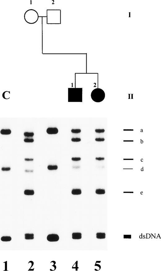 Fig. 5. SSCP analysis of plasminogen gene exon 7 in patients no. 3 and 4 and her parents. Radiolabeled single-stranded PCR products of plasminogen exon 7 were electrophoresed in a nondenaturing 5% polyacrylamide gel as described in Materials and Methods. Lane 1, healthy control (C); lane 2, mother; lane 3, father; lane 4, patient no. 4 with ligneous conjunctivitis; lane 5, patient no. 3. dsDNA, double-stranded DNA. The double-stranded DNA of patients no. 3 and 4 (lanes 4 and 5) and of the mother (lane 2) shows two bands. The shorter band is the mutant allele with a 3-bp deletion (AAG) at position 767-769. Note that alleles a and d of the mother (lane 2) are slightly faster migrating when compared with bands a and d of a healthy control with the wild-type sequence (lane 1). This is due to two polymorphisms, a silent C → T base exchange at position 847 in plasminogen exon 7 (Cys238) and a T → G base exchange at position −15 in plasminogen intron F.
