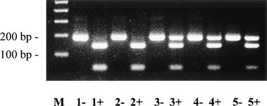 Fig. 6. Direct detection of deletion mutation (Ex17 + 1del-g) in plasminogen intron Q by RFLP analysis. Amplified PCR products of plasminogen exon 17/intron Q were digested with Sty I, electrophoresed in a 2% agarose gel, and visualized by ethidium bromide staining. The (uncut) mutant type PCR fragment has a size of 203 bp; the wild-type Sty I-digested PCR fragment has a size of 143 bp. −, no Sty I added to PCR product; +, Sty I added to PCR product. Lane M, 100-bp ladder; lane 1, healthy control; lane 2, mother of patients no. 3 and 4; lane 3, father of patients no. 3 and 4; lane 4, patient no. 4; lane 5, patient no. 3. The larger (mutant) allele is found after Sty I-digestion in patients no. 3 and 4 (lanes 4+ and 5+, heterozygous) and their father (lane 3+, heterozygous), but not in the healthy control and not in the mother of patients no. 3 and 4 (lanes 1+ and 2+).
