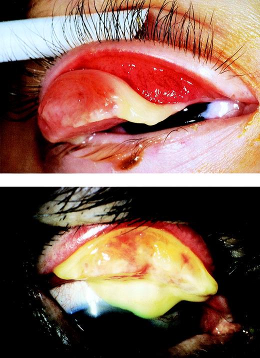 Fig. 1. (A) Ligneous conjunctivitis in patient no. 1. (B) Ligneous conjunctivitis in patient no. 2.
