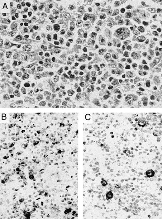 Fig. 2. Transformation of cutaneous T-cell lymphoma. (A) Lymph node biopsy shows a pleomorphic tumor with large to anaplastic nucleolated cells admixed with small lymphocytes with markedly irregular nuclei. The patient had a 10-year history of plaque-type mycosis fungoides before developing nodal transformation. (B) OX40/CD134 immunostain is positive primarily in medium-sized to large cells. (C) CD30 immunostain highlights occasional anaplastic cells with membrane and perinuclear staining.