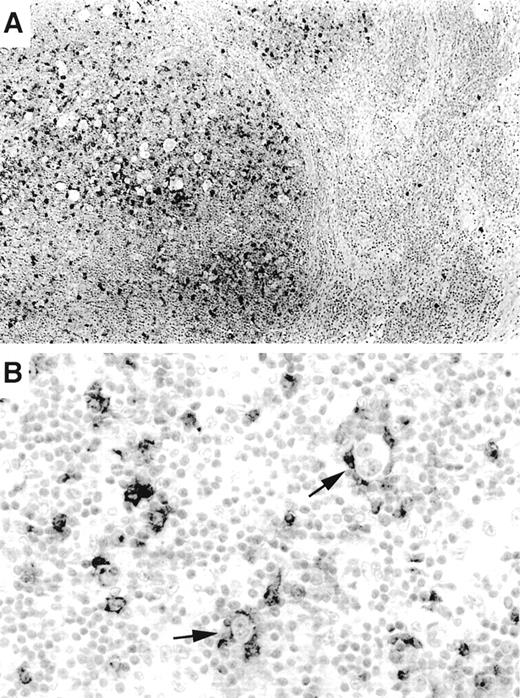 Fig. 3. OX40/CD134 expression in classical Hodgkin’s disease. (A) OX40/CD134 immunostain of nodular sclerosis Hodgkin’s disease shows numerous positive cells within neoplastic nodules. Adjacent uninvolved nodal tissue shows only rare OX40/CD134+cells. (B) OX40/CD134+ benign T cells cluster around RS cells (arrows) with one RS cell showing possible OX40/CD134 membrane staining (lower arrow).