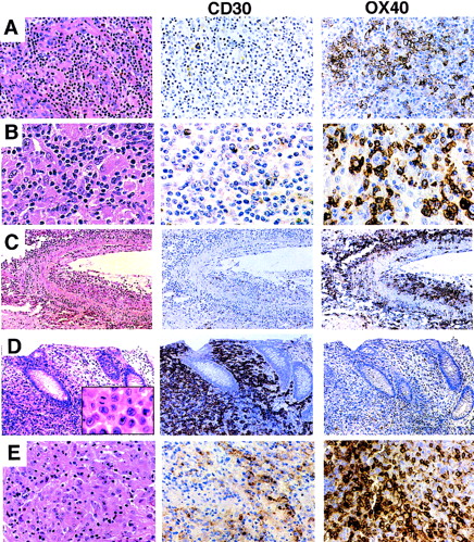 Fig. 1. Expression of CD30 and OX40/CD134 in PTCL. (A) AIL. Biopsy shows a mixed lymphoid infiltrate with numerous thick-walled venules. CD30 immunostain is positive only in scattered plasma cells. OX40/CD134 stain shows clusters of positive cells with membrane and paranuclear staining corresponding predominantly to large tumor cells with clear cytoplasm. (B) Histiocyte-rich (Lennert’s) T-cell lymphoma. Predominantly small lymphocytes are intermixed with numerous epithelioid histiocytes. CD30 stain is negative; OX40/CD134 stain is positive in a majority of the small and large lymphocytes. (C) Angiocentric T-cell lymphoma. Lung with a predominantly large-cell infiltrate showing extensive infiltration of the wall of a large artery. OX40/CD134 staining is present in nearly all of the tumor cells. (D) ALCL. Colon biopsy shows a sheet-like mucosal infiltrate of anaplastic tumor cells (inset). CD30 stain is uniformly positive; OX40/CD134 stain marks occasional reactive T cells. Immunostain for ALK protein was strongly positive (not shown). (E) ALCL with a Hodgkin’s-like appearance. Tumor shows areas of strong CD30 staining and other distinct areas with strong OX40/CD134 reactivity.
