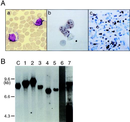 Fig. 1. Clonal origin of EBV-infected NK cell leukemia. (A) NK leukemia cells in peripheral blood bear a morphology of large granular lymphocytes (a) (May-Grünwald-Giemsa staining; original magnification × 1,000); NK leukemia cells in peripheral blood (case no. 1) (b) and in the liver (case no. 1) (c) expressed EBER1 RNA on in situ hybridization, indicating that virtually all NK cells were infected with EBV. (B) Southern blot analysis of DNA extracted from NK-enriched PBMCs showed that each sample possessed a single joined terminal sequences of the EBV genome (EcoRI digestion), indicating their clonal origin from a single EBV-infected NK cell. The numbers on the top of each lane correspond to case numbers listed in Table 1. “C” is a positive control DNA from EBV-infected lymphoepithelioma that contains a single episomal from of EBV.