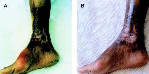 Fig. 1. The deep chronic leg ulcer in patient no. 2 (A) before and (B) at the end of therapy.