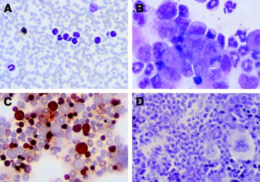 Fig. 2. Tissue sections from CY-treated Nf1+/− mice with MPD. (A and B) Blood and bone marrow smears showing immature and well differentiated myeloid cells. (C) A cytocentrifuge preparation of spleen cells stained with the myeloid lineage marker nonspecific esterase demonstrates many positive cells (brown stain). (D) A spleen section shows a dense infiltrate of myeloid cells within the red pulp.