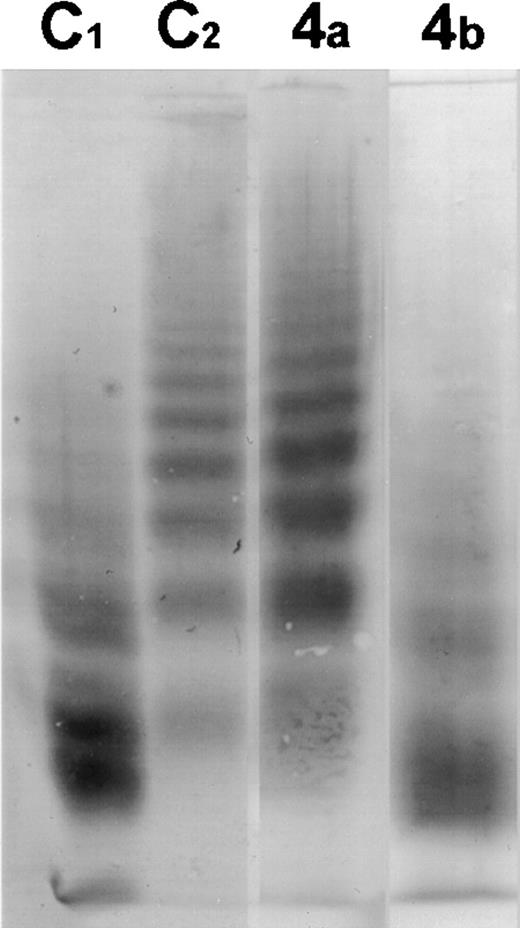 Fig. 1. Western blot of the multimeric pattern of vWF R834Q after incubation with plasma from patient 4 suffering from classic TTP before (4A) and after (4B) plasma exchange. C1, plasma from a healthy donor incubated with vWF R834Q. C2, plasma from a healthy donor incubated with vWF R834Q in the presence of EDTA (1 mmol/L).