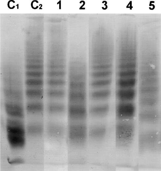 Fig. 2. Western blot of the multimeric pattern of vWF R834Q after incubation with plasma from patients suffering from classic TTP. C1, plasma from a healthy donor incubated with vWF R834Q. C2, plasma from a healthy donor incubated with vWF R834Q in the presence of EDTA (1 mmol/L). Lanes 1 through 5, patient plasmas (numbers as in Table 1).