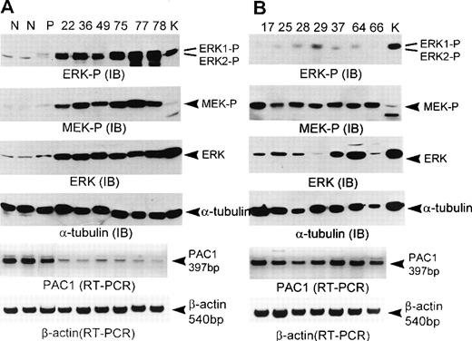 Fig. 1. Complementary role of MEK activation, ERK hyperexpression, and PAC1 downregulation in determining the activation of ERK in human acute leukemias. Normal unselected BM (N), purified CD34+ (P), and acute leukemia samples were subjected to immunoblot (IB) and RT-PCR analysis as described in Materials and Methods. For immunoblot analysis, lysates containing the same amount of protein were applied to each lane; 25 μg of protein for phosphorylated ERK1/2 (ERK-P); 50 μg of protein for phosphorylated MEK1/2 (MEK-P); 25 μg of protein for total ERK1/2 (ERK); 25 μg of protein for -tubulin. In all immunoblot analyses, K562 samples (K) were loaded together as the evidence of same exposure time in autoradiogram. Separated proteins were transferred to the immobilon-P membrane and stained with phospho-specific ERK1/2 antibody or phospho-specific MEK1/2 antibody or total ERK1/2 antibody or -tubulin antibody, respectively. In immunoblot analysis of total ERK using 25 μg protein, the ERK1 band was not visualized because ERK1 detected by total ERK1/2 antibody was much less abundant than ERK2. For RT-PCR analysis, PCR was performed with PAC1 primer for 22 cycles, with β-actin primers for 25 cycles. PCR products derived from 20 ng of total RNA were applied to each lane. Leukemia samples above the lanes from (A) to (D) correspond with those in Table 1.