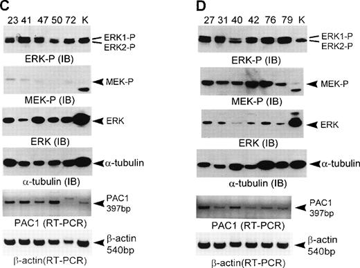 Fig. 1. Complementary role of MEK activation, ERK hyperexpression, and PAC1 downregulation in determining the activation of ERK in human acute leukemias. Normal unselected BM (N), purified CD34+ (P), and acute leukemia samples were subjected to immunoblot (IB) and RT-PCR analysis as described in Materials and Methods. For immunoblot analysis, lysates containing the same amount of protein were applied to each lane; 25 μg of protein for phosphorylated ERK1/2 (ERK-P); 50 μg of protein for phosphorylated MEK1/2 (MEK-P); 25 μg of protein for total ERK1/2 (ERK); 25 μg of protein for -tubulin. In all immunoblot analyses, K562 samples (K) were loaded together as the evidence of same exposure time in autoradiogram. Separated proteins were transferred to the immobilon-P membrane and stained with phospho-specific ERK1/2 antibody or phospho-specific MEK1/2 antibody or total ERK1/2 antibody or -tubulin antibody, respectively. In immunoblot analysis of total ERK using 25 μg protein, the ERK1 band was not visualized because ERK1 detected by total ERK1/2 antibody was much less abundant than ERK2. For RT-PCR analysis, PCR was performed with PAC1 primer for 22 cycles, with β-actin primers for 25 cycles. PCR products derived from 20 ng of total RNA were applied to each lane. Leukemia samples above the lanes from (A) to (D) correspond with those in Table 1.