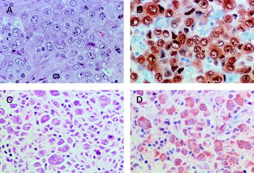 Fig. 1. Representative photomicrographs of a T-cell ALCL case stained with H&E (A) and polyclonal anti-ALK antibody ALK11 (B) and a B-cell case stained with H&E (C) and polyclonal anti-ALK antibody ALK11 (D). Original magnification × 400.