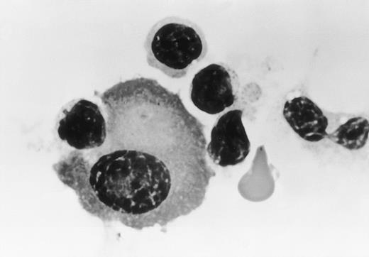 Fig. 4. Morphology of effector cells attacking myeloma cells. Myeloma cells were purified from the bone marrow (patient no. 1) and were cultured with PBMCs from a healthy donor in the presence of humanized anti-HM1.24 MoAb (1 μg/mL) for 30 minutes. Cytospin preparations were stained with Wright-Giemsa (original magnification × 330).