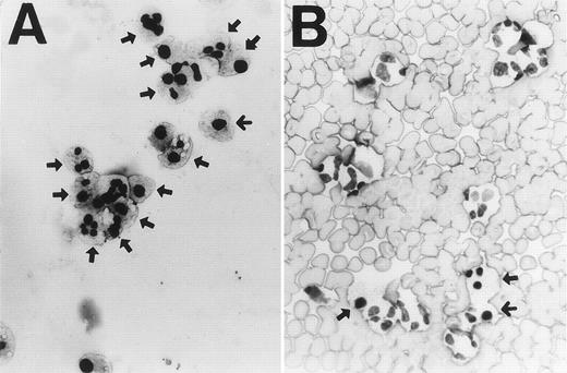 Fig. 2. Light microscopy of neutrophils cultured for 24 hours without (A) or with (B) RBCs at a ratio of 1:100 (×400). Arrows indicate apoptotic cells showing nuclear pyknosis or chromatin condensation together with cytoplasmic vacuolation. Note apoptosis is inhibited in the presence of RBCs.