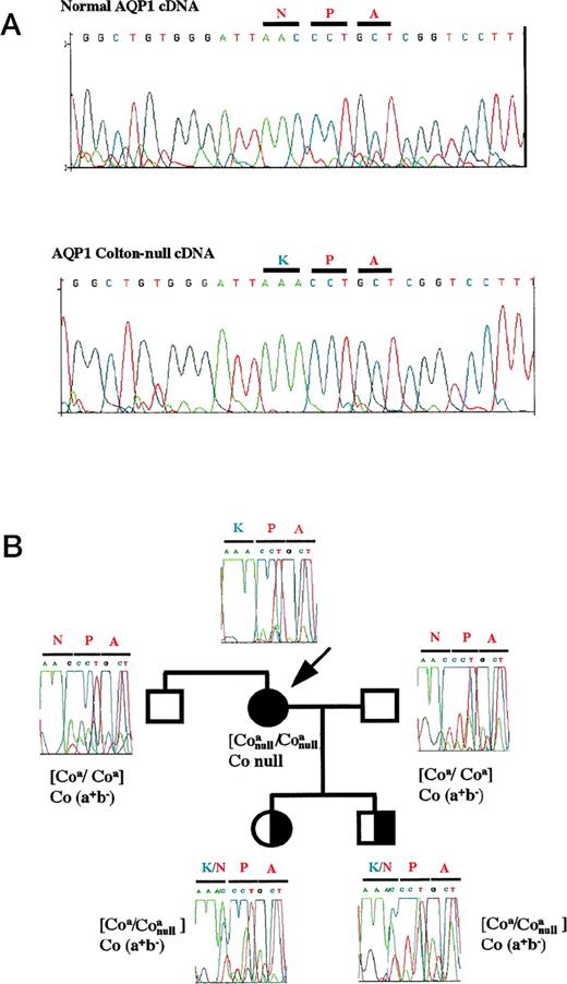 Fig. 1. Identification and inheritance of the Co-null mutation. (A) Direct sequence analysis of normal AQP1 (top) and AQP1 Co-null (bottom) cDNAs displaying a mutation in the codon 192 of NPA motif. Primers used for PCR: 5′-TCGGGCCAGGGCCTGGGCAT-3′ (sense, nucleotides 441 to 460) and 5′-CTACAGTATGGATTTCACCC-3′ (anti-sense, 911 to 930). (B): Inheritance of the Co-null mutation in the propositus (arrow) family. Genomic DNA from blood cells of the different members of the Colton-null family were isolated and direct sequence analysis was performed with the primers: 5′-CCCCTCCCTCTGTTTCTTTCCC-3′ (sense, intron B) and 5′-CTACAGTATGGATTTCACCC-3′ (anti-sense, 911 to 930 exon 4).