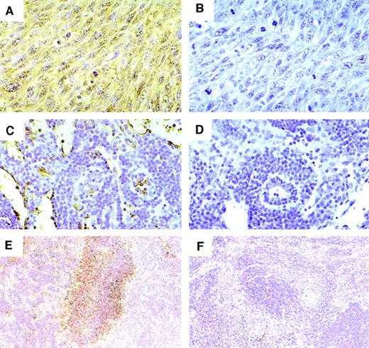 Fig. 5. Detection of VEGF by immunohistochemical staining. (A and B) Tumor (original magnification × 40); (C and D) lymph node (original magnification × 200); and (E and F) spleen (original magnification × 100) from mice with vIL-6–producing tumors. Sections were stained with (A, C, and E) rabbit anti-VEGF Ab or (B, D, and F) control rabbit IgG. Sections were reacted with diaminobenzidine peroxidase substrate and counterstained with hematoxylin. Diffuse staining of the tumor cells (A) and focal staining of lymph node (C) and splenic white pulp area (E).