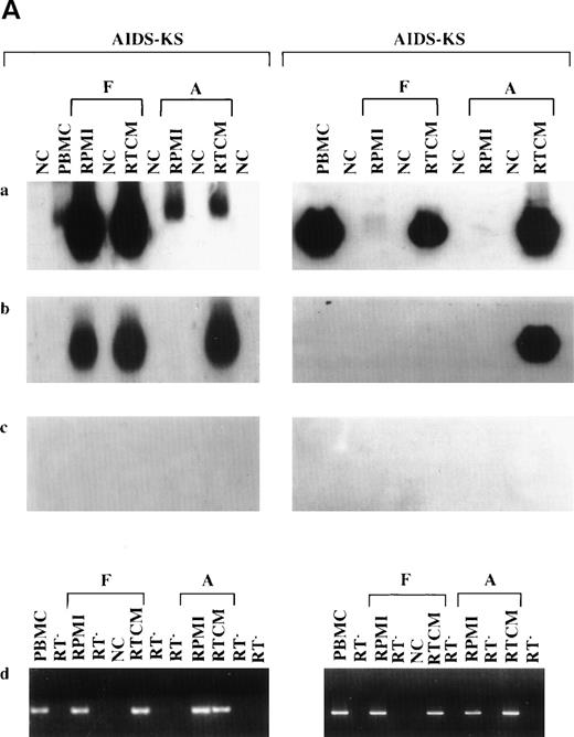 Fig. 2. (A) Detection of latent and lytic viral gene expression in total PBMC at day 0 and in floating or adherent cells cultured with or without IC from 2 patients with AIDS-KS. (a) RT-PCR and hybridization for T0.7; (b) RT-PCR and hybridization for VP23; (c) RT-PCR and hybridization for T0.7 in the absence of reverse transcriptase; (d) RT-PCR and ethidium bromide staining for human β-actin. NC are negative controls, including Jurkat cells and PCR reactions without DNA template. RT− indicates β-actin RT-PCR reactions performed from the same samples of RNA in the absence of reverse transcriptase. The same number of RTCM-treated and untreated cells were processed and RNA normalized by spectrophotometric determination. (B) ISH detection of HHV-8 lytic (Vp23) gene expression in PBMC from an AIDS-KS patient after culture with RTCM. ISH of (A) PBMC cultured for 72 hours without RTCM (original magnification × 25) and (B) corresponding dark field; (C) PBMC cultured for 72 hours with RTCM (original magnification × 25), arrows point to ISH-positive cells and (D) corresponding dark field; (E) PBMC from a patient not infected by HHV-8 (original magnification × 25) and (F) corresponding dark field; (G) higher magnification showing positive cells with monocytic morphology; a cell with lymphocyte morphology is negative. Several microscopic fields were analyzed and a similar density of positive cells was present in cells cultured in the presence of RTCM. In contrast, cells cultured in the presence of RPMI were always negative. Hybridization to a latency-associated HHV-8 gene probe could not be performed, because cells were not sufficient.