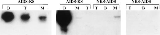 Fig. 3. Detection of HHV-8 DNA in purified cell populations from PBMC of homosexual men with HIV infection. Aliquots of cell lysates (105 cells) were subjected to PCR with primer set 3.PCR products were analyzed by Southern blot hybridization with a32P-labeled oligonucleotide probe internal to the amplified sequences. Shown are the results with B cells (B), monocytes (M), or T cells (T) from 2 AIDS-KS and 2 NKS-AIDS patients. Cell populations were purified as described and purification was monitored by FACS.All samples were positive for β-globin amplification (data not shown). An HIV+ patient was positive in B cells (data not shown). The NKS-AIDS and the HIV+ patients were positive for anti–HHV-8 Ab by IFA.