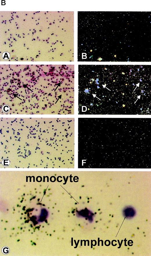 Fig. 2. (A) Detection of latent and lytic viral gene expression in total PBMC at day 0 and in floating or adherent cells cultured with or without IC from 2 patients with AIDS-KS. (a) RT-PCR and hybridization for T0.7; (b) RT-PCR and hybridization for VP23; (c) RT-PCR and hybridization for T0.7 in the absence of reverse transcriptase; (d) RT-PCR and ethidium bromide staining for human β-actin. NC are negative controls, including Jurkat cells and PCR reactions without DNA template. RT− indicates β-actin RT-PCR reactions performed from the same samples of RNA in the absence of reverse transcriptase. The same number of RTCM-treated and untreated cells were processed and RNA normalized by spectrophotometric determination. (B) ISH detection of HHV-8 lytic (Vp23) gene expression in PBMC from an AIDS-KS patient after culture with RTCM. ISH of (A) PBMC cultured for 72 hours without RTCM (original magnification × 25) and (B) corresponding dark field; (C) PBMC cultured for 72 hours with RTCM (original magnification × 25), arrows point to ISH-positive cells and (D) corresponding dark field; (E) PBMC from a patient not infected by HHV-8 (original magnification × 25) and (F) corresponding dark field; (G) higher magnification showing positive cells with monocytic morphology; a cell with lymphocyte morphology is negative. Several microscopic fields were analyzed and a similar density of positive cells was present in cells cultured in the presence of RTCM. In contrast, cells cultured in the presence of RPMI were always negative. Hybridization to a latency-associated HHV-8 gene probe could not be performed, because cells were not sufficient.