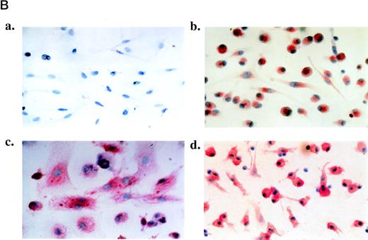 Fig. 4. (A) FACS analysis of PBMC at day 0 and PBMC-derived floating cells cultured for 6 days without TCM (RPMI, day 6) or with TCM (TCM, day 6). T cells were doubly stained for CD3 and CD8 to obtain the percentage of CD8+ T cells (CD3+/CD8+), CD4+ T cells (CD3+/CD8−), CD8+ NK cells (CD3−/CD8+), and non-T cells (CD3−/CD8−). Staining with anti-CD14 and anti-CD20 antibodies was used to identify monocyte and B cells, respectively (left side). Shown are representative examples from 2 patients (upper and lower panels, respectively). Similar results were also obtained with floating cells from other 3 AIDS-KS patients and 1 asymptomatic HIV+ individual analyzed by immunocytochemistry (data not shown). (B) Phenotypic characterization of adherent cells obtained from PBMC of an AIDS-KS patient cultured for 6 days with TCM and analyzed by immunohistochemistry (APAAP method). (a) A representative negative control (isotype-matched control Ab) of adherent cells counterstained by hematoxylin with the typical spindle morphology is shown (original magnification × 400). (b through d) Representative examples of staining for CD68 (b; original magnification × 400), CD14 (c; original magnification × 1,000), and VE-cadherin (d; original magnification × 400) are presented. Nearly 100% of the cells present in these fields showed a specific red staining. The average percentage of positive cells from different fields for all the patients analyzed is shown in Table 5.
