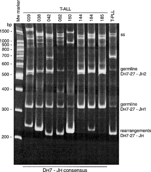 Fig. 2. Heteroduplex PCR analysis of Dh7-27-Jhcross-lineage rearrangements in T-ALL. Subsequent to agarose gel electrophoresis, samples containing PCR products were subjected to heteroduplex PCR analysis, separated in a 6% polyacrylamide gel, and visualized by ethidium bromide staining. Based on the size of clonal PCR products, Dh7-27-Jh rearrangements (∼250 bp) were identified in T-ALL patients T009, T038, T042, T062, T150, and T184 as well as in a T-cell prolymphocytic leukemia (T-PLL). In addition to homoduplexes resulting from Dh7-27-Jhrearrangement, the germline Dh7-27-Jh1 and Dh7-27-Jh2 homoduplexes were consistently present, except for cases with biallelic IGH rearrangements and a very high tumor load (ie, patient T150). To obtain a clonal sequence of Dh7-27-Jh rearrangements, homoduplexes of the correct size were excised from the polyacrylamide gel, eluted, and sequenced. ss, single-strand DNA.