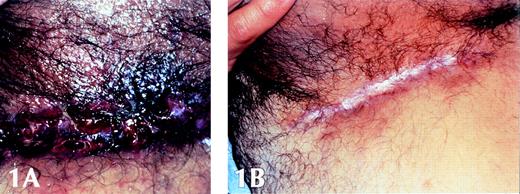 Fig. 1. The inguinal area of patient 6 is shown before (A) and after (B) six courses of cladribine. Pretreatment, the area shows active cutaneous lesions, serosanguineous, and pustular drainage, which has resolved after treatment.
