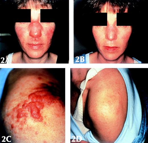 Fig. 2. These photographs show the purple-colored, nodular cutaneous lesions of patient 12. Her face, with the nasal disfigurement, and her right shoulder is shown before (A and C) and after six courses of cladribine therapy (B and D).