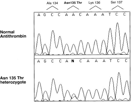 Fig. 2. Selected nucleotide sequence of proband and normal PCR-amplified DNA. All coding regions of the antithrombin gene were amplified and sequenced with an automated sequencer (see Materials and Methods). Only one region was found with a sequence difference between normal and patient products, and this difference is illustrated along with its predicted amino acid change.