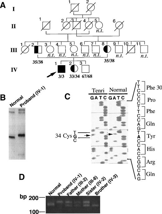 Fig. 1. Identification of the mutation site in factor XII Tenri. (A) Pedigree of the factor XII Tenri family. Affected subjects with reduced factor XII levels are shadowed and the proband is indicated by an arrow. Deceased family members and unexplored subjects are indicated by ○/ or □/ and n.t., respectively. Antigen/activity levels of factor XII are shown. (B) LIS-SSCP analysis of exon 3 of factor XII gene. PCR fragments of exon 3 derived from a normal subject (left) and the proband (right) were analyzed by LIS-SSCP as described in Materials and Methods. (C) Nucleotide sequence showing the A to G substitution in exon 3 of the factor XII Tenri gene. This substitution mutates Tyr34 to Cys in the type II domain of factor XII. (D) PCR-Kpn I digestion analysis of the factor XII Tenri family. For each member, exon 3 amplified by PCR as described in Materials and Methods was digested with KpnI and subsequently analyzed by agarose gel electrophoresis. PCR product from normal allele showed a cleaved fragment of 141 bp, whereas that from Tenri-type allele showed an uncleaved band of 163 bp.