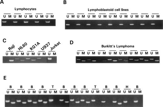 Fig. 1. MSP of DAP-Kinase. Primer sets used for amplification are designated as unmethylated (U) or methylated (M). The size of the MSP product for the unmethylated reaction is 106 bp. The size of the MSP product for the methylated reaction is 98 bp. In all MSP reactions, 10λ of product was run on a 6% polyacrylamide gel, stained with ethidium bromide, and visualized under UV illumination. (A) MSP analysis of DNA from lymphocytes of 6 normal individuals shows amplification of only unmethylated alleles in the DAP-Kinase CpG island. (B) MSP of DAP-Kinase in lymphoblastoid cell lines (cell lines immortalized by EBV-transformation) shows amplification of only unmethylated alleles in the DAP-Kinase CpG island. (C) MSP of DAP-Kinase in cell lines. Raji shows amplification of only methylated alleles for the DAP-Kinase CpG island. U937, an expressing cell line, shows amplification of only unmethylated alleles for the DAP-Kinase CpG island. (D) MSP of DAP-Kinase in Burkitt’s lymphoma samples. Each sample shows aberrant methylation of the DAP-Kinase CpG island. None of these samples was microdissected, so the unmethylated alleles amplified in each sample represent either normal tissue found within the tumor samples or heterogeneity of aberrant methylation within the tumor sample itself. (E) MSP of DAP-Kinase in lymphoma samples. Samples: B, B-cell non-Hodgkin’s lymphoma; T, T-cell non-Hodgkin’s lymphoma; H, Hodgkin’s lymphoma. The majority of the B-cell non-Hodgkin’s lymphoma samples show aberrant methylation of the DAP-Kinase CpG island, and none of the T-cell non-Hodgkin’s lymphoma samples do.