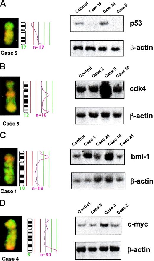 Fig. 3. Partial CGH karyotypes, corresponding ratio profiles, and Southern blot analysis of different MCLs. Hybridized tumor DNA was labeled with Spectrum Red-dUTP and control DNA with Spectrum Green-dUTP. On the right side of the ideograms, the average ratios of tumor/normal fluorescence are plotted. The central line indicates a ratio value of 1.0; lines on the left side indicate ratio values of 0.75 and 0.5, respectively; lines on the right side indicate ratio values of 1.25 and 1.5, respectively. n = number of chromosomes analyzed for calculating the respective average ratio profile. β-ACTIN probe was used as loading control in all Southern blots. (A) (Left) Partial CGH karyotype of case 5. A reduction of 17p arm is visible. (Right) Southern blot analysis of DNA of the same case (case 5), another case with a similar chromosome 17 profile (case 15), an additional case with normal chromosome 17 profile (case 20), and DNA from lymphocytes of a healthy control. Both cases with 17p loss by CGH (cases 5 and 15) showed homozygous deletions of P53gene. (B) (Left) Partial CGH karyotype of case 5. A gain of 12q13 is visible. (Right) Southern blot analysis of DNA of the same case (case 5), another case with gain of 12q by CGH (case 2), an additional tumor with normal chromosome 12 profile (case 10), and DNA from lymphocytes of a healthy control. Densitometric evaluation showed an amplification of CDK4 gene in case 5. (C) (Left) Partial CGH karyotype of case 1. An intense, band-like hybridization signal mapping to chromosomal band 10p12-p13 is observed. (Right) Southern blot analysis of DNA of the same case (case 1), another tumor with a similar profile of chromosome 10 (case 16), two additional tumors with normal chromosome 10 profile (cases 20 and 25), and DNA from lymphocytes of a healthy control. Densitometric evaluation showed an amplification ofBMI-1 gene. (D) (Left) Partial CGH karyotype of case 4. An intense, band-like hybridization signal mapping to chromosomal band 8q24 is observed. (Right) Southern blot analysis of DNA of the same case (case 4), two additional tumors with normal chromosome 8 profile (cases 9 and 3), and DNA from lymphocytes of a healthy control. Densitometric evaluation showed an amplification of C-MYC gene.