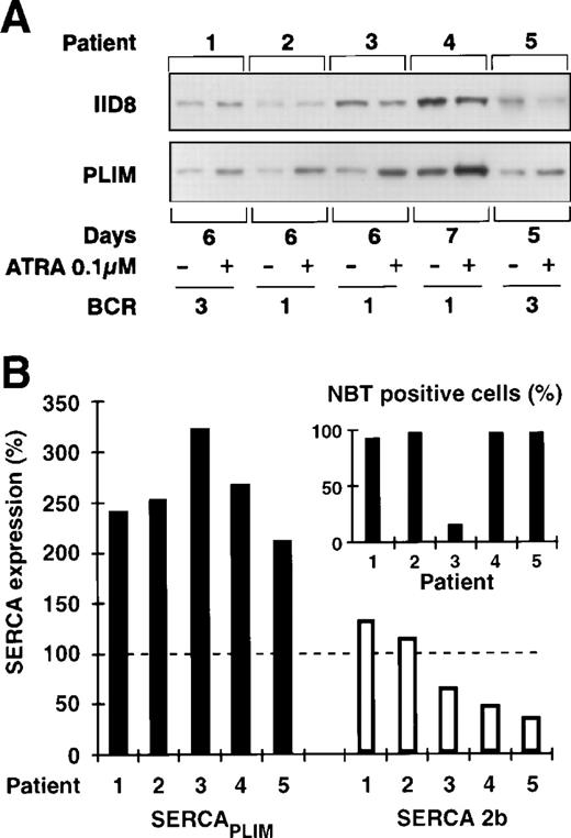 Fig. 5. Effect of ATRA treatment on the SERCA expression of fresh APL cells. Freshly isolated APL blasts were treated by 0.1 μmol/L ATRA over 7 days and SERCA expression; cell differentiation was also determined. (A) Immunoblot analysis of SERCA 2b and SERCAPLIM expression. (B) Modulation of SERCA expression upon ATRA treatment. One hundred percent refers to SERCA expression levels in untreated cells. (▪) SERCAPLIM; (□) SERCA 2b. Treatment resulted in a marked induction of SERCAPLIMexpression. (Inset) The percentage of NBT-positive cells after ATRA treatment.