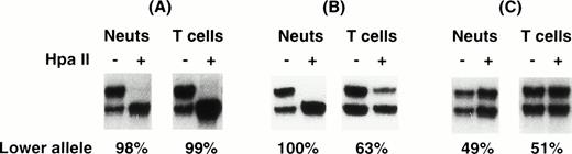 Fig. 2. Representative HUMARA analyses of DNA from neutrophils and T cells of ET patients in each of the results groups: (A) XCIPs skewed in both samples, (B) neutrophil XCIP skewed, T-cell XCIP balanced, and (C) both XCIPs balanced.