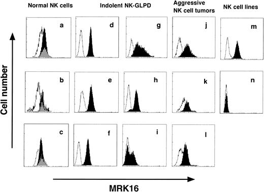Fig. 1. P-gp expression on NK cells. (a through c) are NK cells from normal donors, (d through l) are those from patients, and (m) and (n) are NK cell lines. (d through l) correspond to patients 1 through 9 of Table 1, respectively. (m) is the cell line NK92, and (n) is the cell line NKL. Dark zone shows the results with MRK16 MoAb, and clear zone shows the results with control IgG2a MoAb. In normal NK cells (a through c), P-gp was measured in two subsets, CD16+CD56+ (dark zone) and CD16−CD56+ (gray zone).