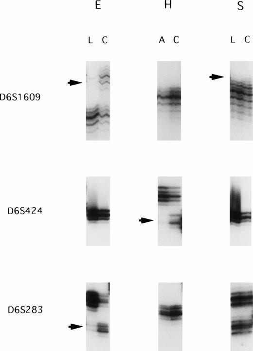 Fig. 1. Representative autoradiographs showing LOH in patients E, H, and S. Loss of one parental band was observed in the acute/lymphoma ATL samples (arrows). L, DNA samples isolated from the lymphoma cells; C, DNA samples isolated from the corresponding normal peripheral leukocytes after complete remission; A, DNA samples isolated from the leukemic cells in acute type.
