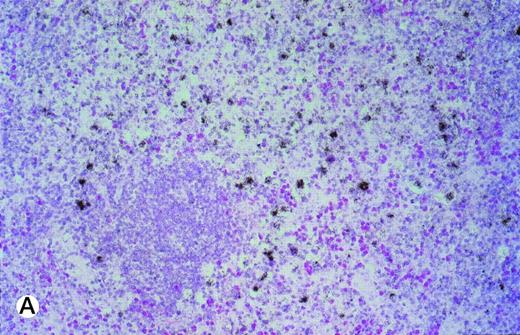 Fig. 3. (A and B) TRAF1 in situ hybridization of two cases of classical HD. (A) represents a case of the nodular sclerosis subtype (exposure, 6 weeks; original magnification × 175), whereas a case of the mixed cellularity subtype is shown in (B) (exposure, 6 weeks; original magnification × 350). Note the distinct label of the tumor cells in both cases.