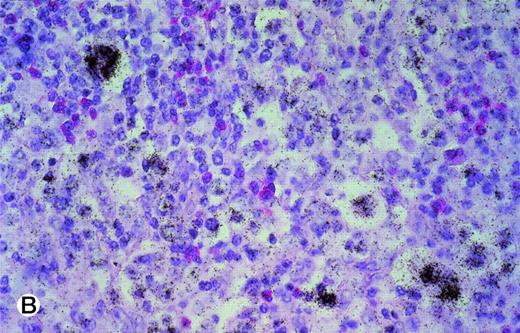Fig. 3. (A and B) TRAF1 in situ hybridization of two cases of classical HD. (A) represents a case of the nodular sclerosis subtype (exposure, 6 weeks; original magnification × 175), whereas a case of the mixed cellularity subtype is shown in (B) (exposure, 6 weeks; original magnification × 350). Note the distinct label of the tumor cells in both cases.