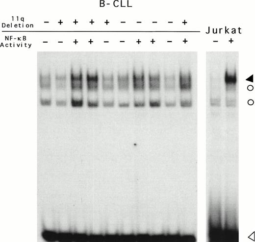 Fig. 3. DNA-binding activity of the transcription factor NF-κB by B-CLL cells with or without 11q deletion detected using a32P-labeled oligonucleotide probe containing a high-affinity NF-κB binding site. Shown are also the scores of NF-κB activity. The Jurkat cells stimulated with TNF- served as positive control (+) and unstimulated Jurkat cells were used as negative control (−) for NF-κB-activity. The solid arrowhead indicates the position of NF-κB DNA complexes. (○) Nonspecific activity binding to the probe. The open arrowhead shows unbound oligonucleotide.