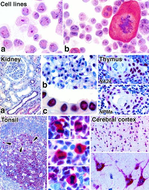Fig. 2. Immunostaining of cytocentrifuged cell lines and paraffin-embedded normal tissues for NPM (APAAP technique). Cell lines: The t(2;5)-positive cell line Karpas 299 (a) and a murine mastocytoma cell line (b) both show labeling of nucleoli with antibody to the C-terminal portion of NPM (antibody NPMc). Note the cytoplasmic labeling of a mitotic cell in (b). Kidney: (a) Many cells show nuclear labeling for nucleophosmin. (b) and (c) show high power views of, respectively, a glomerulus and tubular epithelium (antibody NA24). Thymus: Two different anti-NPM antibodies give essentially identical labeling patterns of cell nuclei in a Hassall’s corpuscle and in the surrounding medullary tissue. Tonsil: Nuclear labeling of lymphoid cells is seen. The arrows in the low power view (left) indicate scattered mitotic cells in which there is cytoplasmic labeling, seen at high power on the right (antibody NA24). Cerebral cortex: Neural cells show strong cytoplasmic staining, seen at low power (above) and high power (below) (antibody NA24).