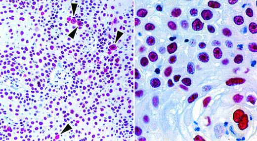 Fig. 3. In a squamous cell carcinoma, the nuclei of all cells are labeled (antibody NA24 APAAP technique). Occasional mitotic cells (arrows) show diffuse cytoplasmic labeling.