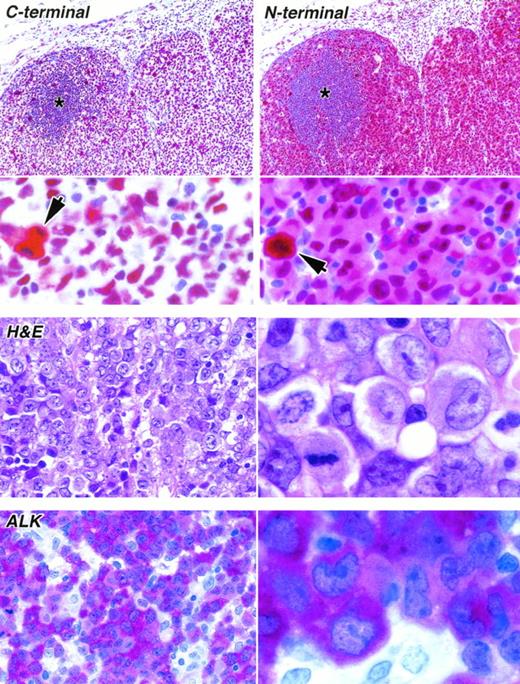 Fig. 4. Staining of paraffin sections of an ALK-positive ALCL (APAAP technique). (Upper) The reactivity of the same area of lymph node with antibodies to the C-terminal epitope (antibody NPMc) and to the N-terminal region (antibody NA24) is seen at low power (above) and high power (below). The tumor cells surround a residual area of normal B cells (asterisks). A clear difference between the labeling patterns of the two antibodies is seen even at low magnification, accounted for by the reactivity of the anti–N-terminal antibody with tumor cell cytoplasm. Scattered mitotic cells showing diffuse cytoplasmic labeling are seen in both sections (arrowed) and can be picked out in the low-power view of the immunostaining for the C-terminus. (Lower) The appearance of the tumor in sections stained by hematoxylin and eosin and for ALK protein is shown at low power (left) and high power (right).