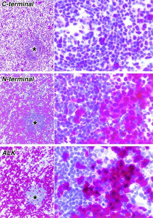 Fig. 5. Staining of paraffin sections of a second ALK-positive ALCL seen at low (left) and high (right) power (APAAP technique). As in the case shown in Fig 4, a clear difference is seen between the immunostaining for the C-terminal epitope (antibody NPMc) and an N-terminal epitope (antibody NPMa). Immunostaining for ALK is also shown. In the lower power view, the corresponding areas in three sections are shown. The asterisks indicate residual normal lymphoid tissue surrounded by tumor cells.
