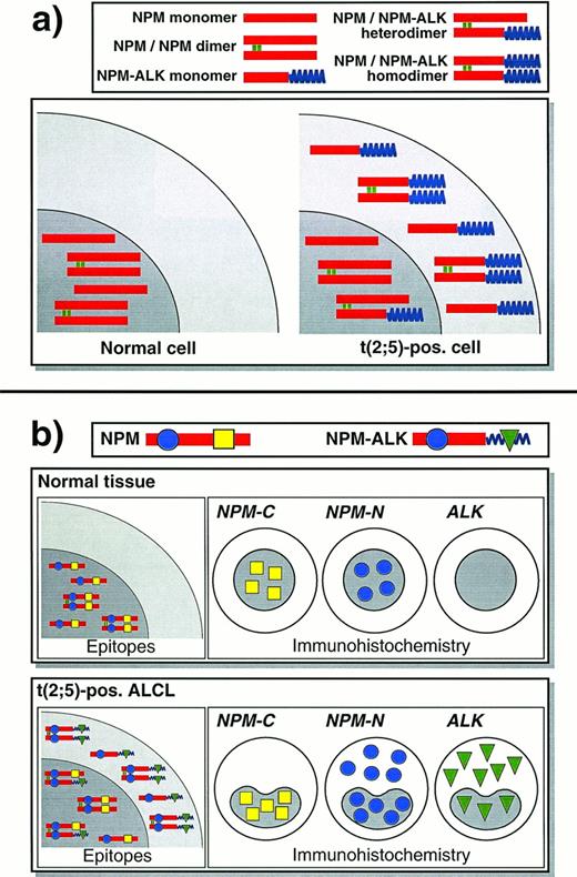 Fig. 6. Schematic diagram of NPM and ALK proteins in normal cells and in t(2;5)-positive lymphoma cells and the resulting immunostaining patterns. This scheme assumes that NPM and NPM-ALK are present in both monomeric and dimeric forms in approximately equal numbers, and does not show larger oligomers that might form.5 It may thus represent an oversimplification of what occurs in vivo. (a) In a normal cell, NPM is confined to the nucleus. In a cell carrying the (2;5) translocation, NPM-ALK is found in the cytoplasm and other NPM-ALK that has heterodimerized with wild-type NPM has acquired nuclear localization. (b) Immunostaining for N- and C-terminal epitopes of NPM and for ALK show distinctive patterns, reflecting the localization of the proteins in the scheme shown above.