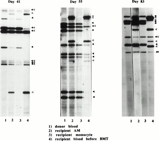 Fig. 6. Banding patterns of DNA fingerprints from three different donor-recipient sets on days 41, 55, and 83 after allo-BMT. DNA fingerprints were produced from HinfI-digested genomic DNA prepared from donor blood cells (1), recipient AM after BMT (2), recipient monocytes (3), and recipient blood cells before BMT (4), as described in Materials and Methods. The characteristic bands for donor (▴) and recipient (▵) are shown.