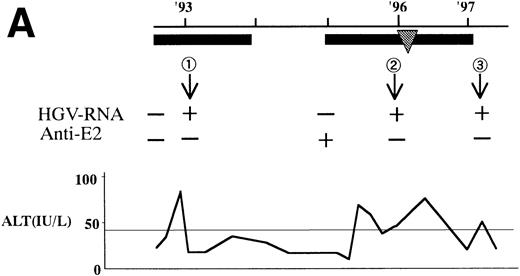 Fig. 1. (A) HGV markers and serum ALT levels of a patient (patient no. 12) with relapse of HGV viremia during chemotherapy. The patient was 14 years old at development of ALL. The horizontal line and solid bar mean years from diagnosis and periods under immunosuppressive therapy or chemotherapy, respectively. The inverted triangle indicates the timing of BMT. In the clinical course of ALT, the normal range for ALT is indicated as a horizontal line. Phylogenetic analysis was performed with the strains obtained at the timing of figures in the circle. (B) Phylogenetic analysis of different HGV isolates from the patient with reactivation of HGV infection. Figures in the circles show the strains from patient no. 12. Homology of nucleotide sequence of 312-bp E2 cDNA between reappearing and former isolates from patient no. 12 were 98% to 99%, although the homology among the other sequences was 79.8% to 88.3%. In the phylogenetic tree, HGV R10291 and PNF2164 are in the same E2 regions of the original HGV strain, and GBV-C is also in the original. We sequenced two strains derived from another patient (patient no. 15), and the strain first appearing showed just the same nucleotide sequence as the other that was obtained 2 years later. D90600, 90601, 87262, 87263, and U63715 are the accession numbers of previously reported HGV or GBV-C sequences in GenBank. Numbers 1 through 10 are strains derived from Taiwanese patients reported by Kao et al.18 (C) HGV markers and serum ALT levels of another patient (patient no. 15) with reactivation of HGV viremia during chemotherapy. Clinical courses are represented by similar notations as in (A).