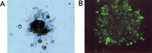 Fig. 3. (A) Appearance of a tumor cell colony grown for 20 days in methylcellulose in LTBMC medium supplemented with EGF and IGF (original magnification, ×100). (B) Immunofluorescence staining of cells picked from tumor cell colonies shown in (A) after staining with FITC-labeled anticytokeratin antibodies (original magnification, ×40).