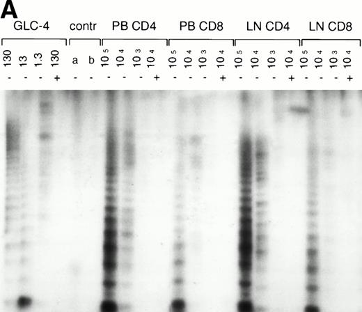 Fig. 4. Telomerase activity in lymph nodes and bone marrow from HIV-infected patients. (A) Telomerase activity in extracts equivalent to 105, 104, and 103 purified CD4+ and CD8+ T cells isolated from PB (CD4 and CD8) and lymph node tissue (LN, CD4 and CD8) shown for one representative HIV-infected individual. (B) Telomerase activity in CD4+ and CD8+ T cells isolated from PB and LN from four HIV-infected individuals, as analyzed by the original TRAP assay. (C) Telomerase activity in extracts equivalent to 104, 103, and 102 total bone marrow cells from two HIV-infected patients after AIDS diagnosis and two HIV− controls. Total bone marrow cell samples contained approximately 40% to 45% CD3+ cells, 4% CD19+ cells, and 2% CD34+ cells. In bone marrow samples from the AIDS patients, the percentage of CD4+ cells was decreased (6.5% compared with 15% in HIV− samples) and the percentage CD8+ cells was increased (30% compared with 18%).