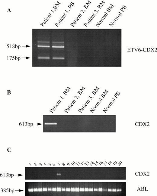 Fig. 3. RT-PCR analysis from patient and control cDNAs. (A) ETV6-CDX2 (primers TG and R4) from patients 1, 2, and 3, normal BM and PB leukocytes. (B) CDX2 (primers R6 and R4) from the same patients and (C) CDX2 and ABL from 10 patients with myeloid blast crisis of CML (lanes 1 through 10) or AML (lanes 11 through 20).