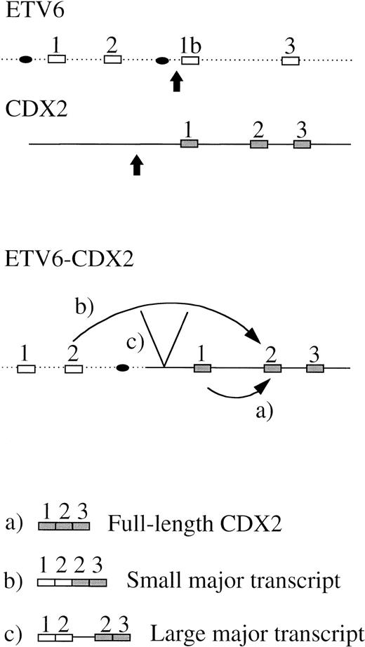 Fig. 5. Schematic diagram to illustrate a possible mechanism for expression of an apparently normal full-length CDX2 transcript (a) and ETV6-CDX2 fusion transcripts (b and c). (▪, exon; •, promoter; , breakpoint).